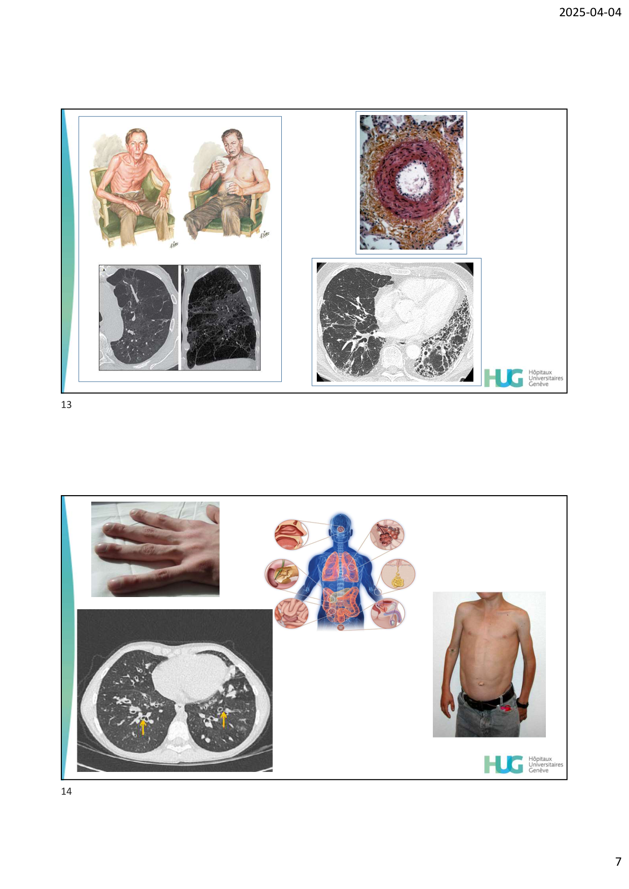 COURS TX PULMONAIRE dia étudiants page 7