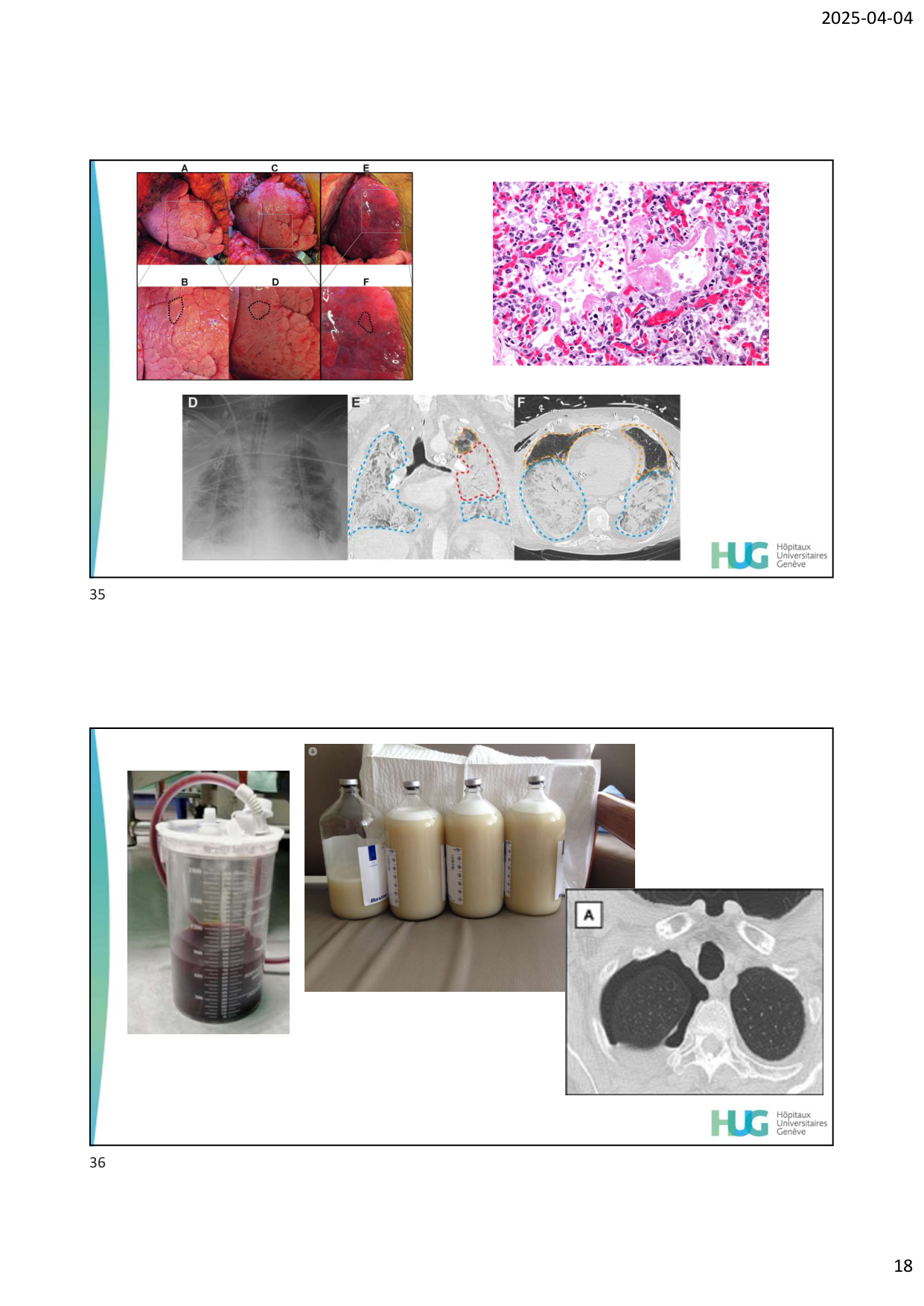 COURS TX PULMONAIRE dia étudiants page 18