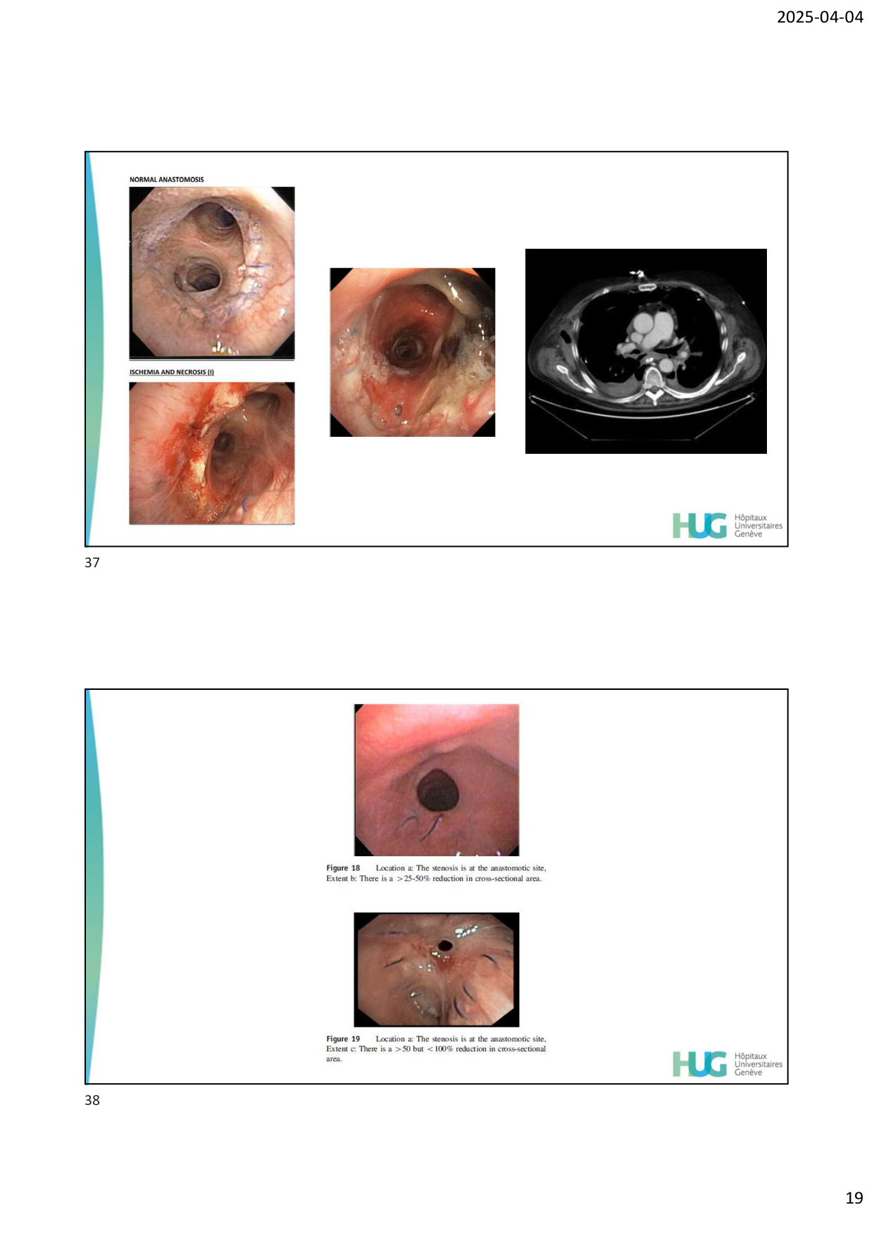 COURS TX PULMONAIRE dia étudiants page 19