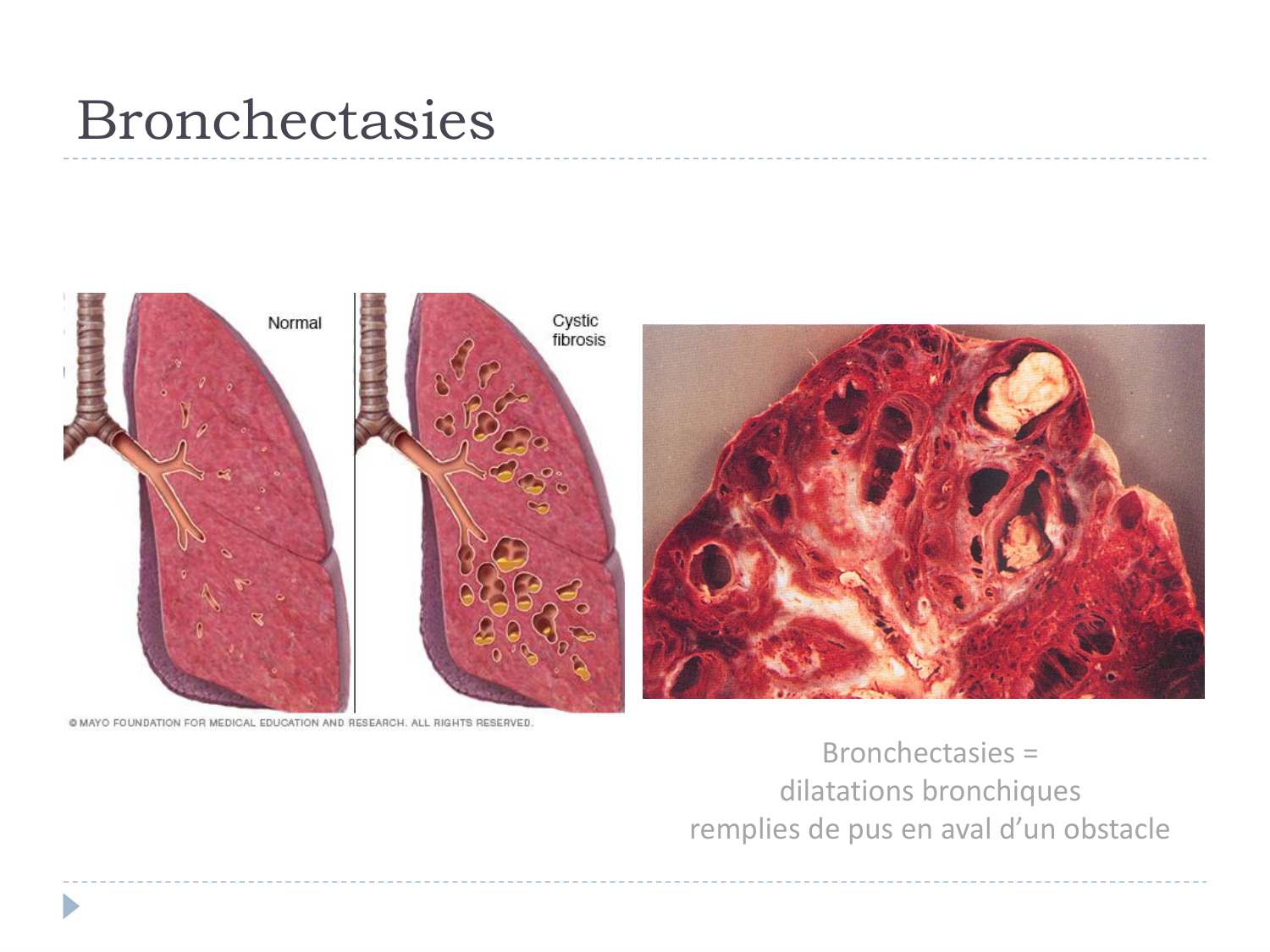 Cours Muco 6- atteinte pulm AMornand page 13
