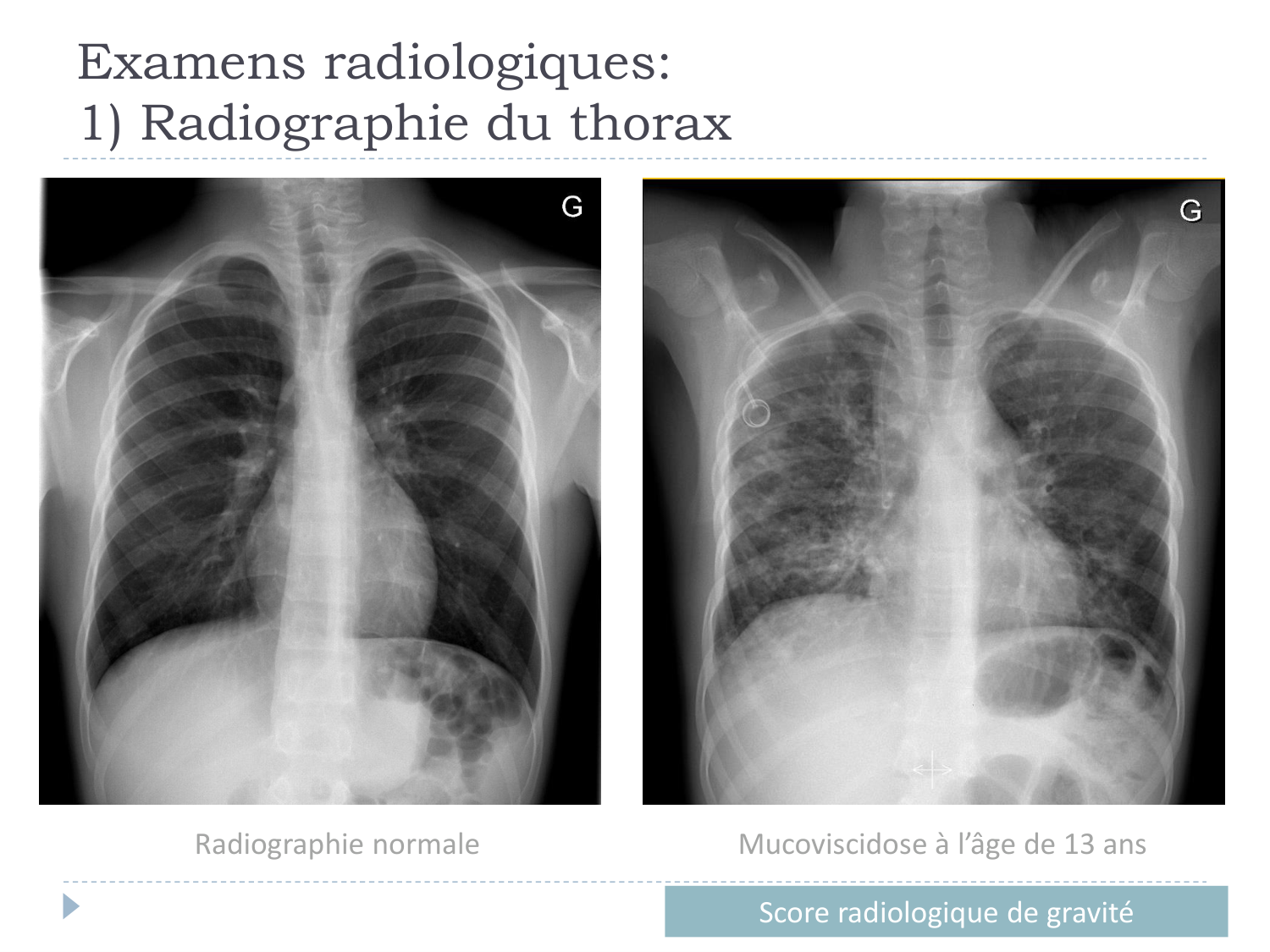 Cours Muco 6- atteinte pulm AMornand page 20