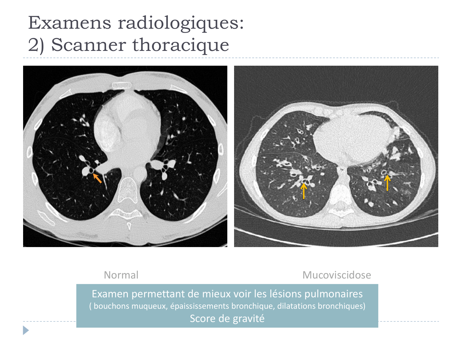 Cours Muco 6- atteinte pulm AMornand page 21