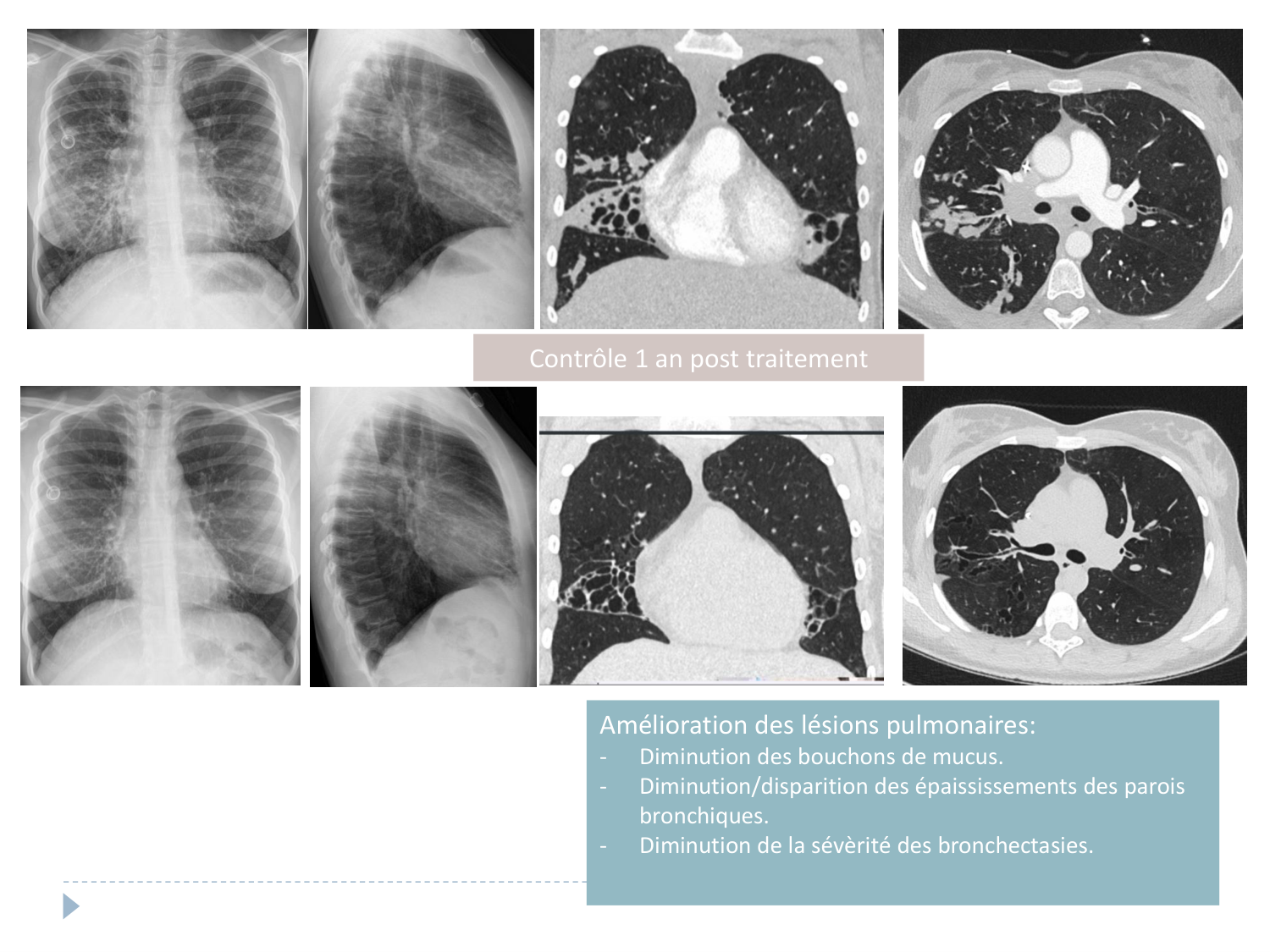 Cours Muco 6- atteinte pulm AMornand page 36