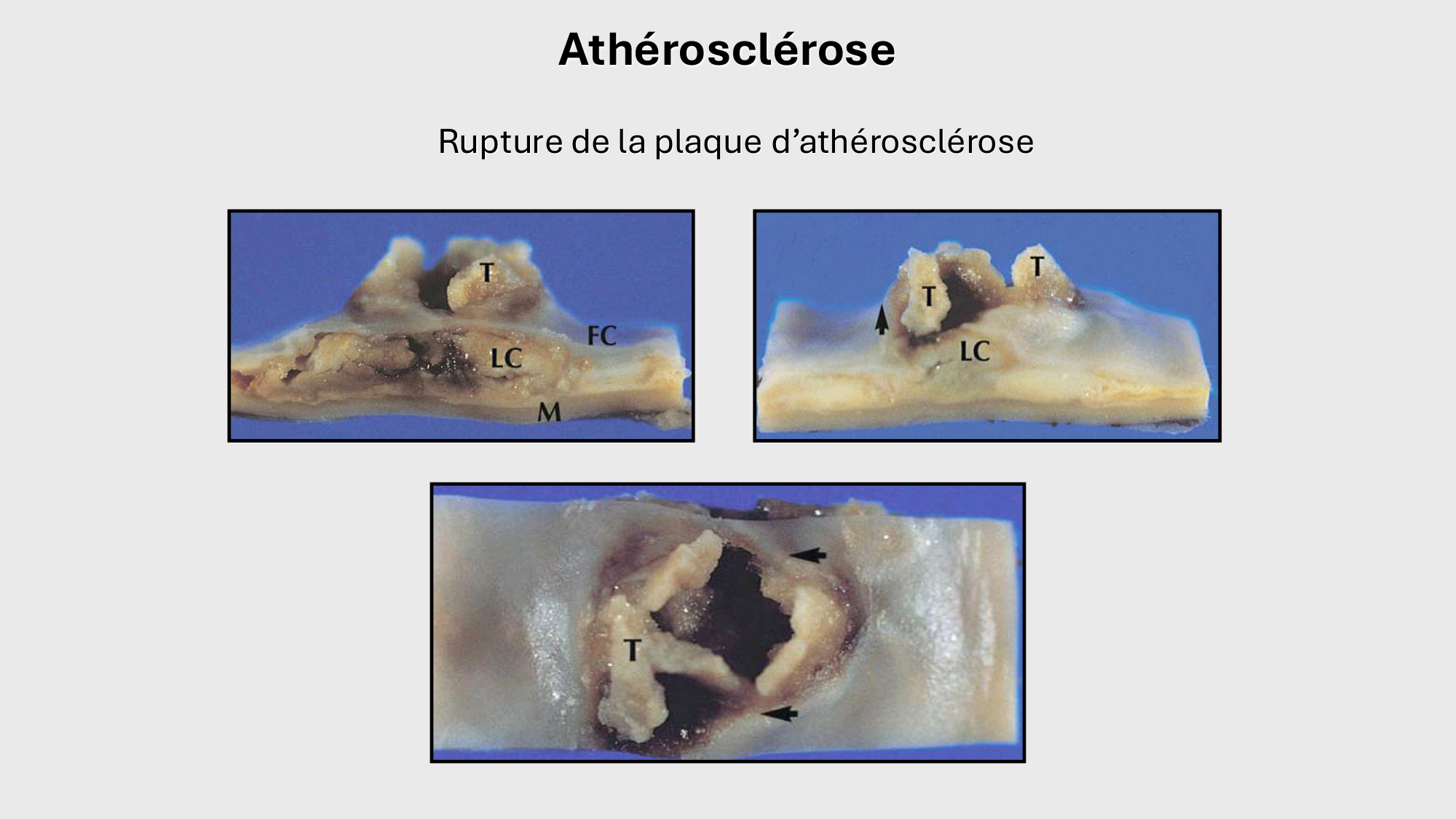 F-Mach-Cas de-liaison-Athero-1-2025 page 39