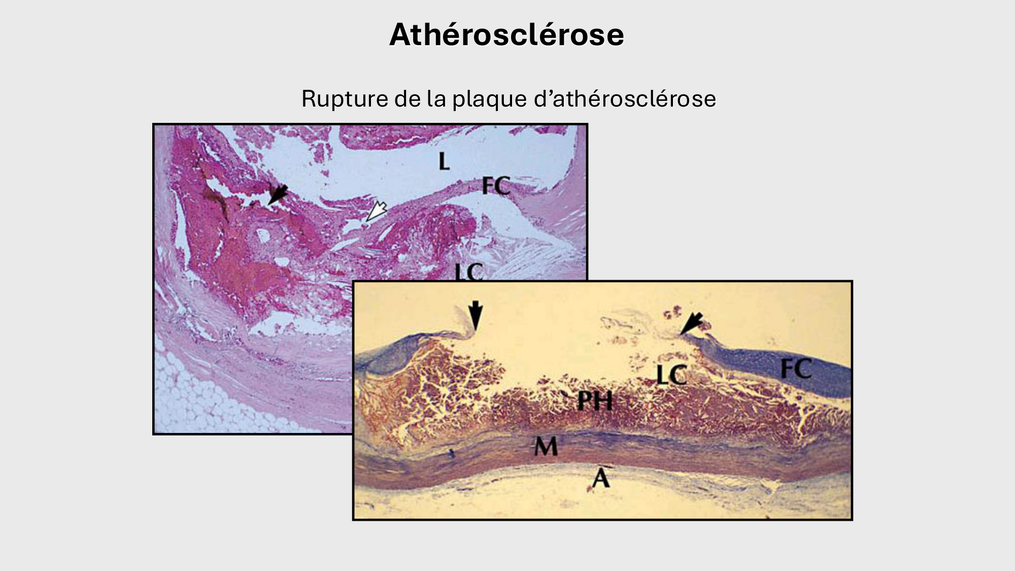 F-Mach-Cas de-liaison-Athero-1-2025 page 40