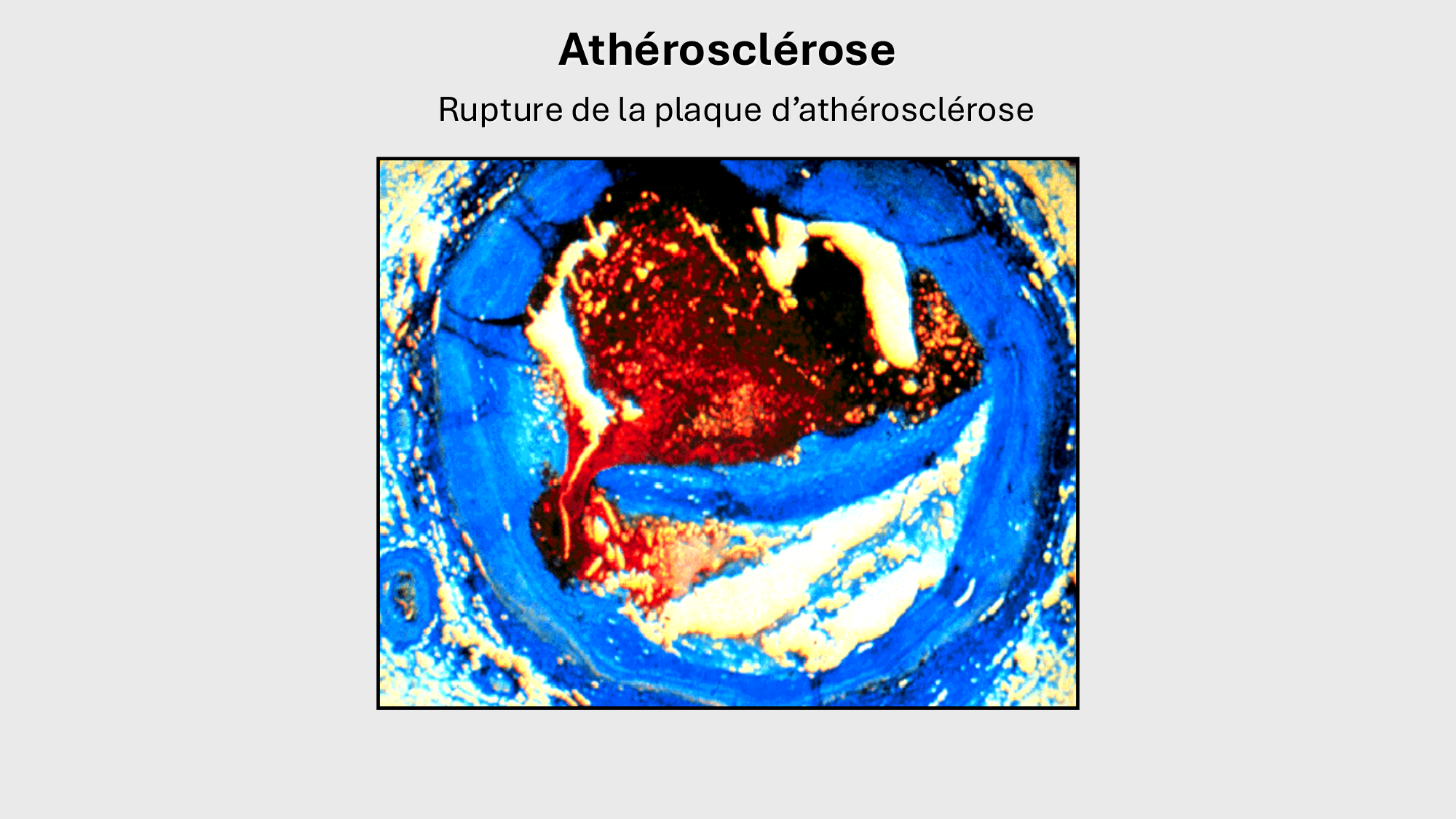 F-Mach-Cas de-liaison-Athero-1-2025 page 42