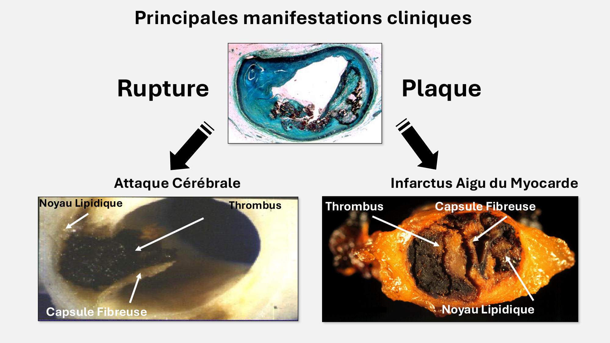 F-Mach-Cas de-liaison-Athero-6-29.1.2026.pdf page 2