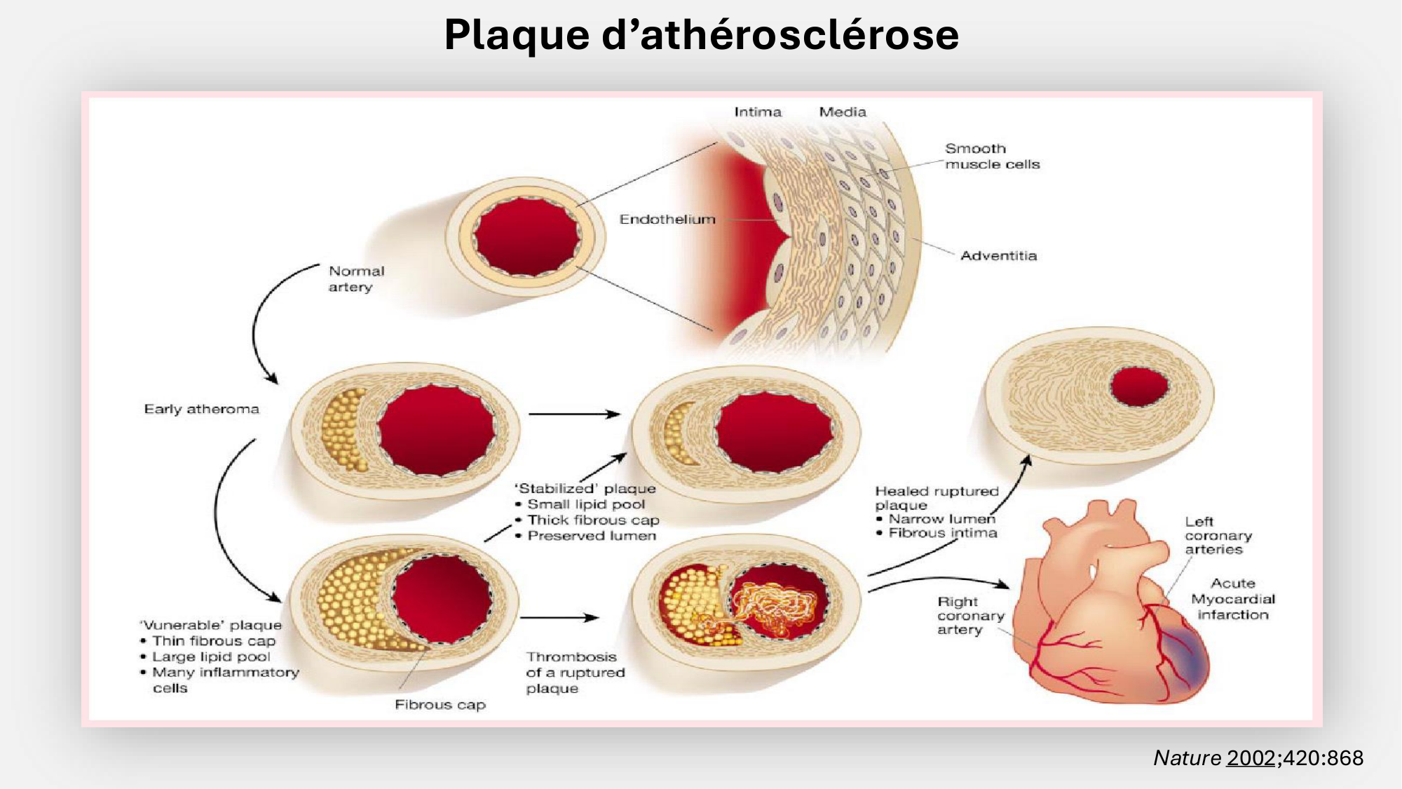 F-Mach-Cas de-liaison-Athero-6-29.1.2026.pdf page 30
