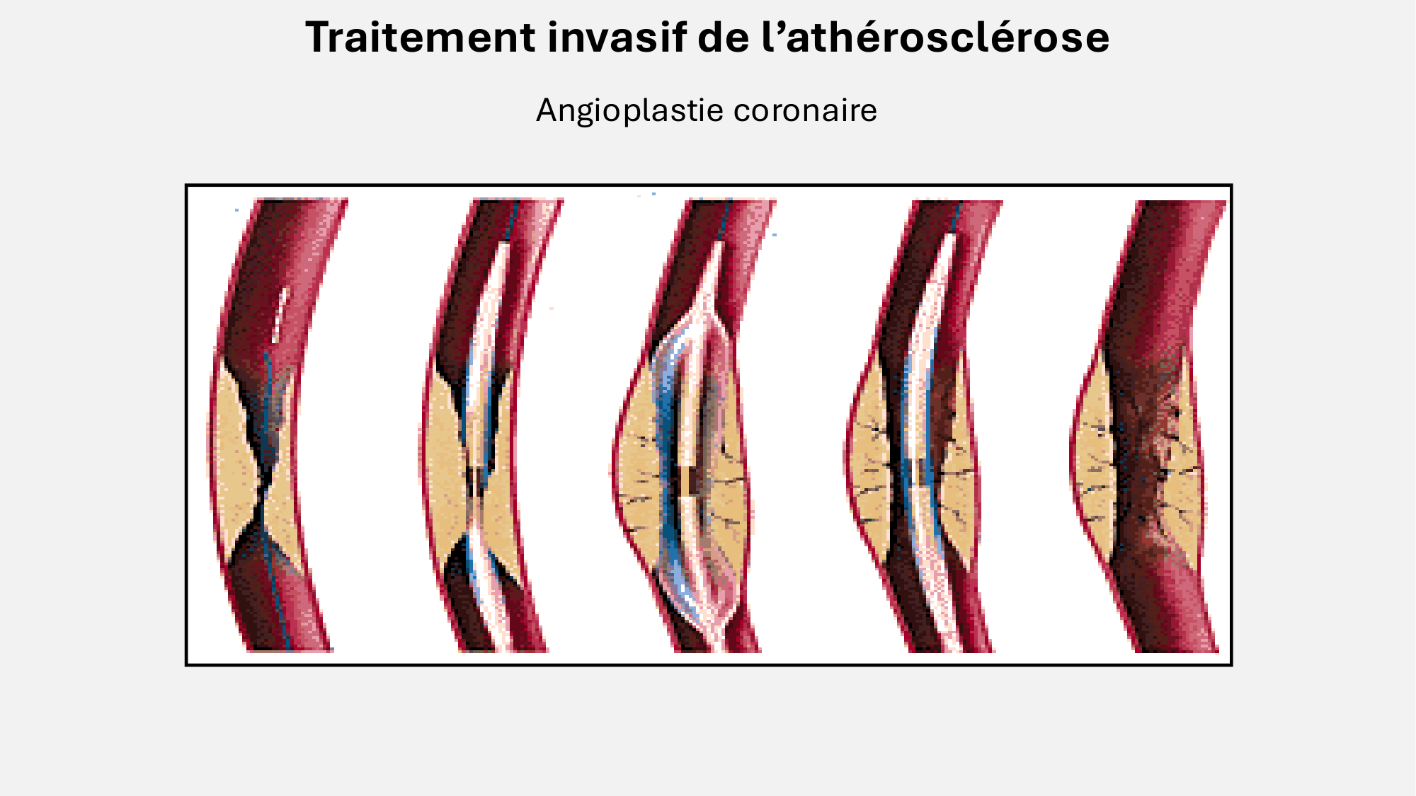 F-Mach-Cas de-liaison-Athero-7-5.3.2026 page 22