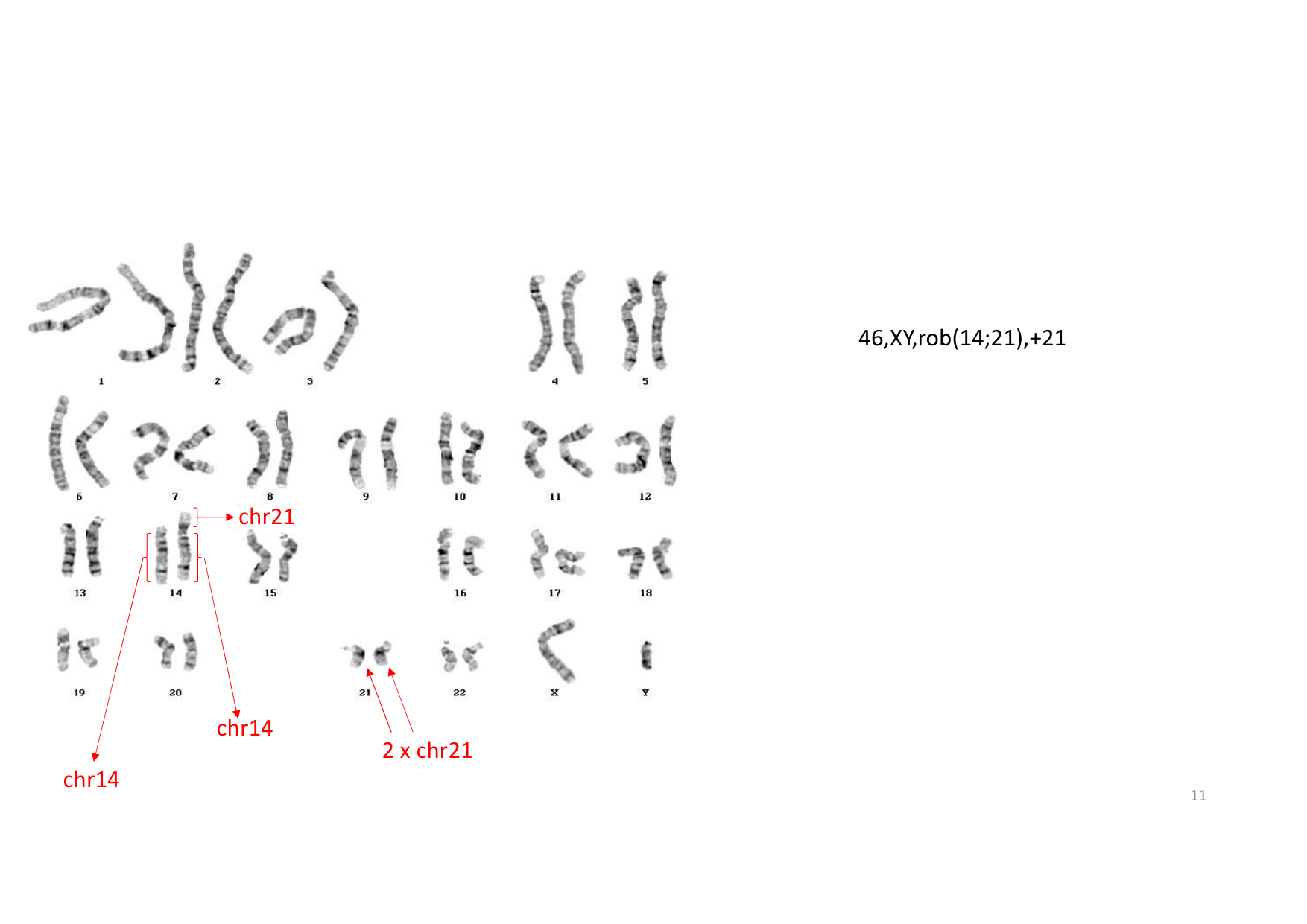 TD de génétique humaine · corrections page 11
