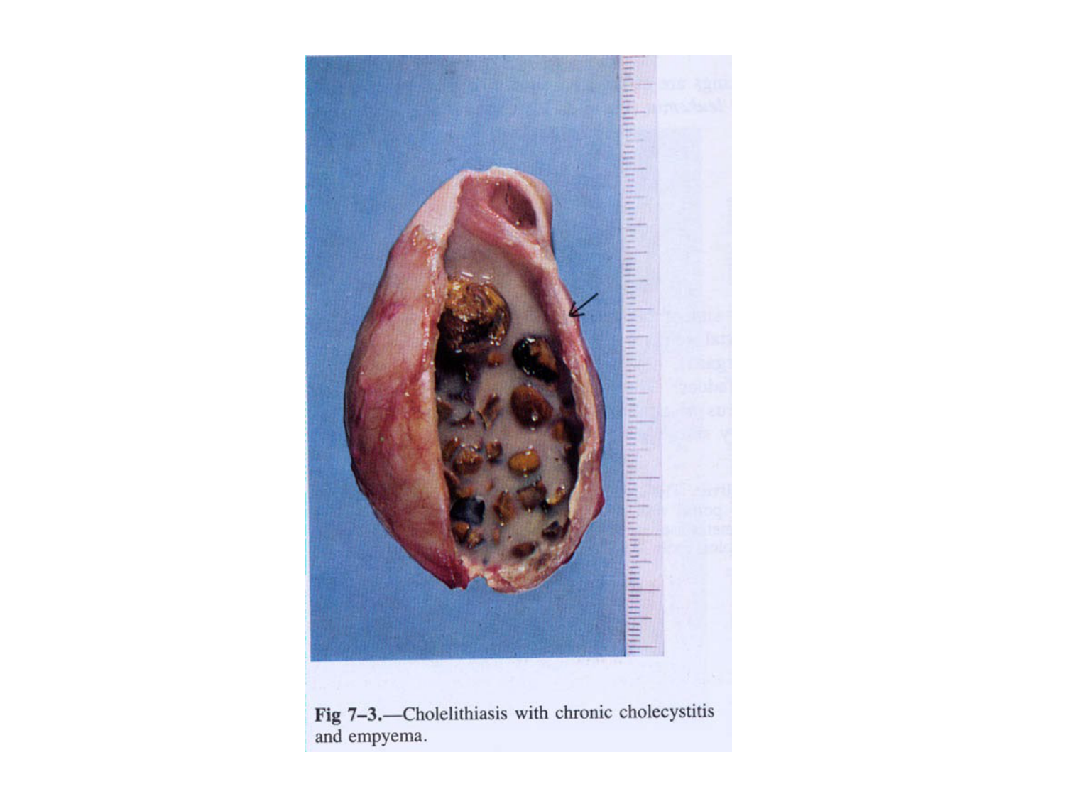 Abdomen gros intestin foie rate pancreas vascularisation page 55