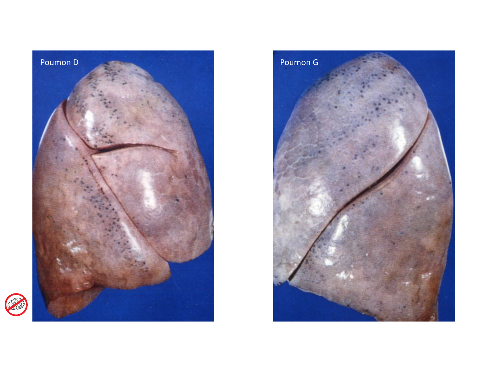 Anatomie pulmonaire 2025 2026 page 22