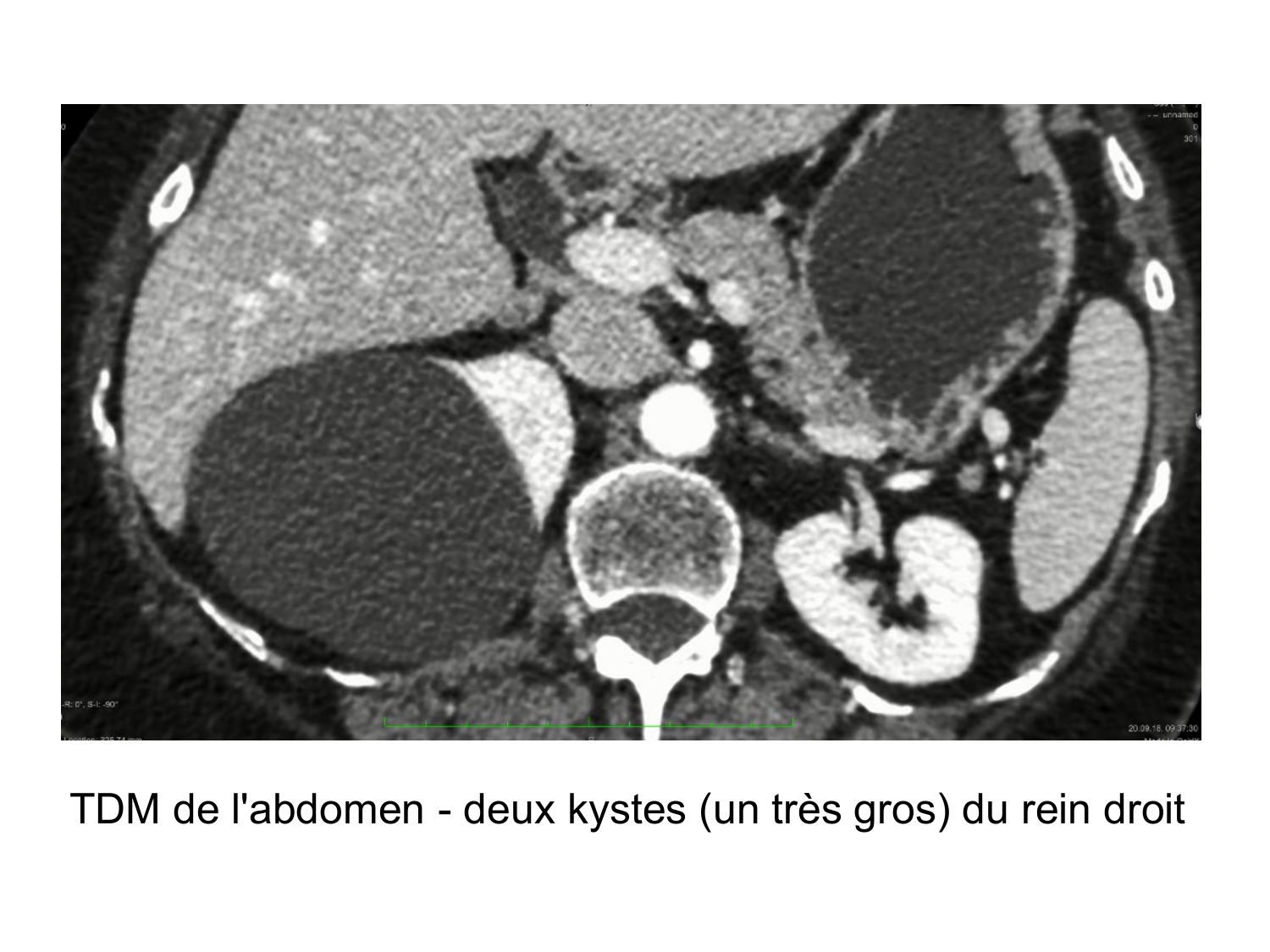 Rein, voies urinaires et retropéritoine page 10