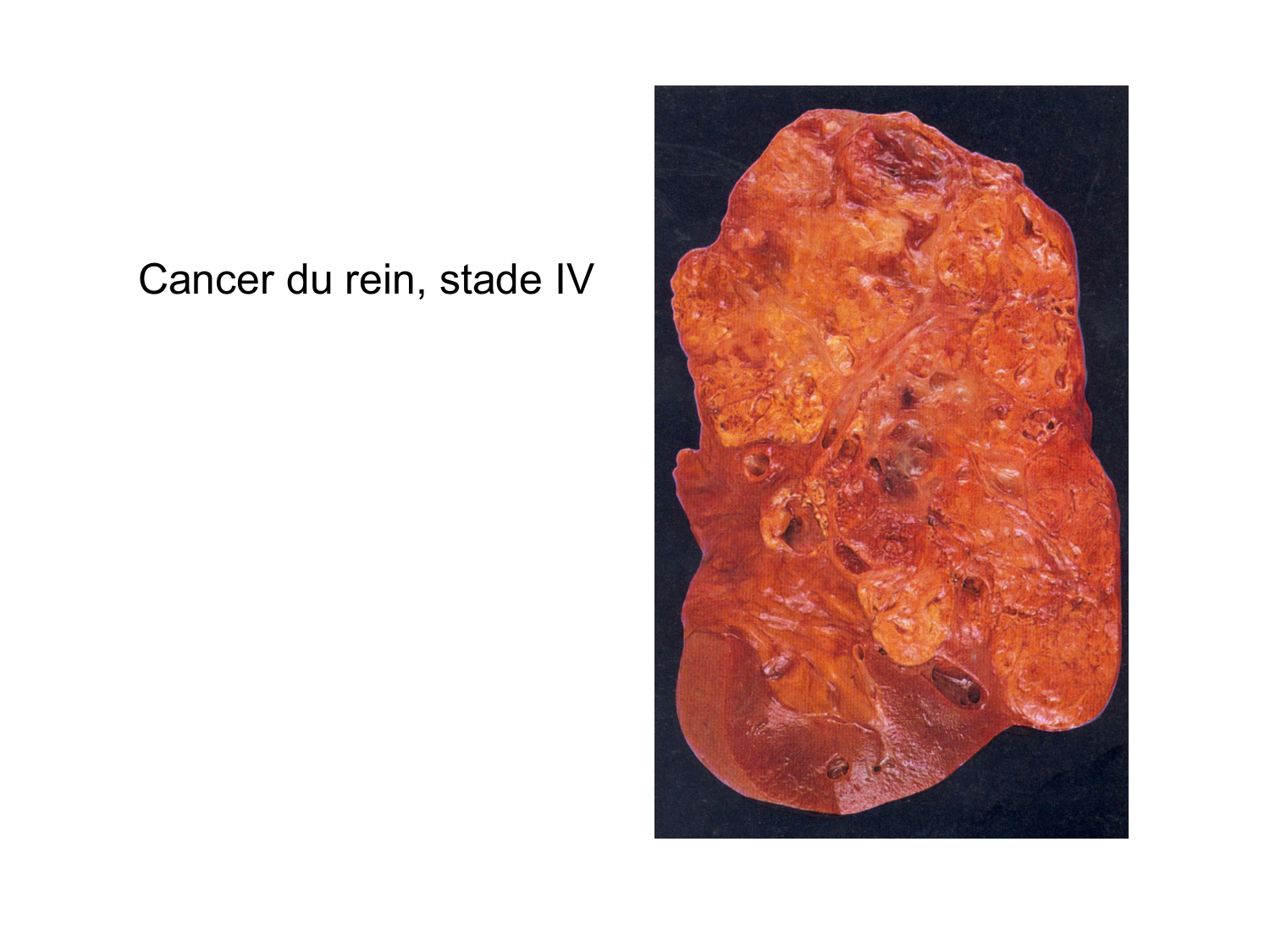 Rein, voies urinaires et retropéritoine page 39