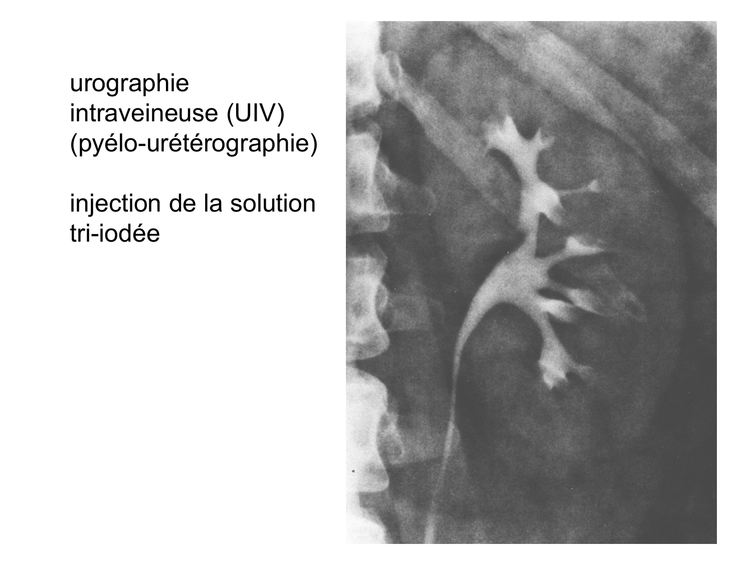 Rein, voies urinaires et retropéritoine page 44