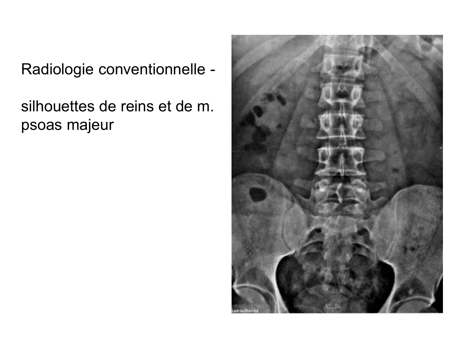 Rein, voies urinaires et retropéritoine page 46