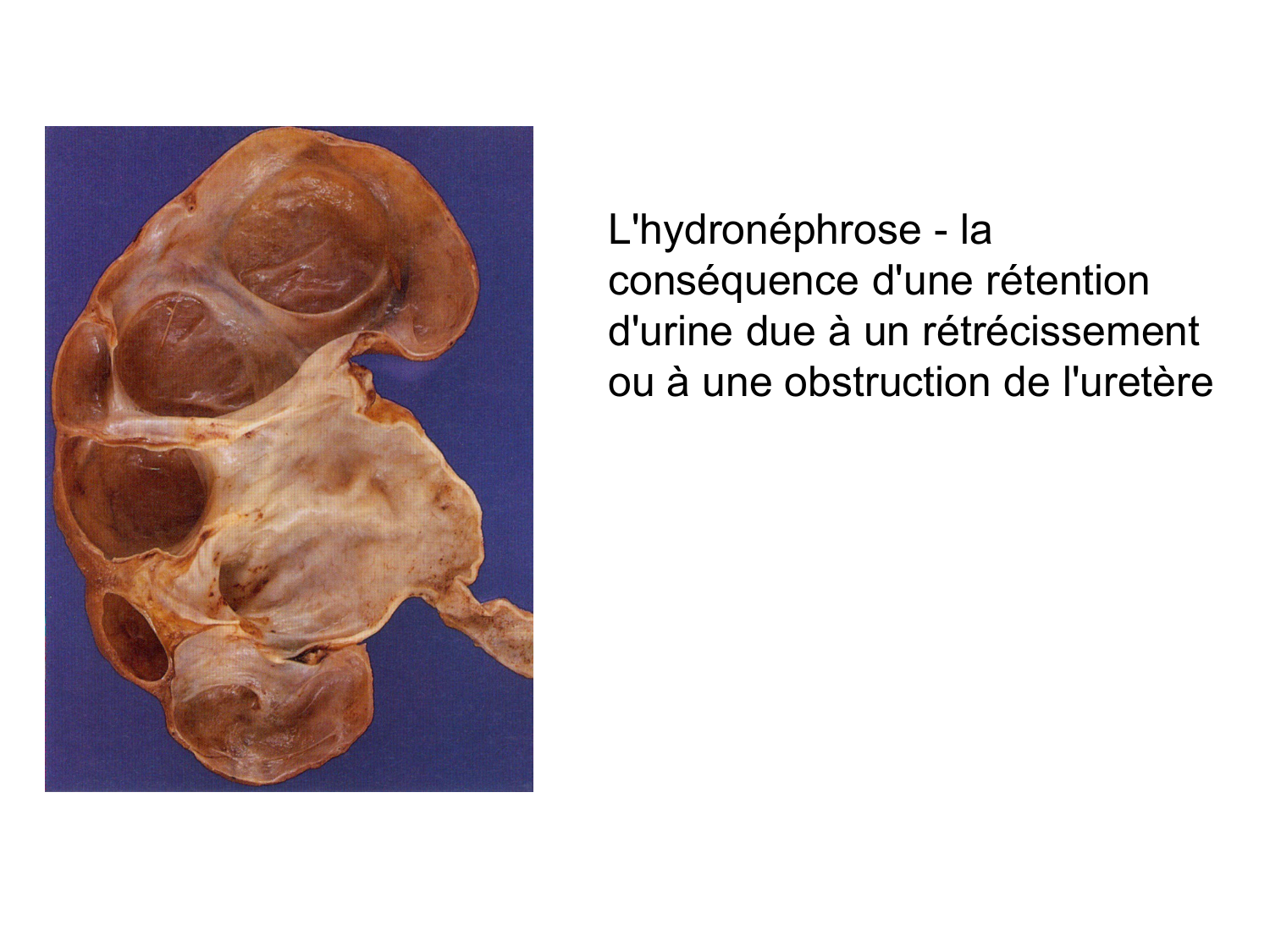Rein, voies urinaires et retropéritoine page 53