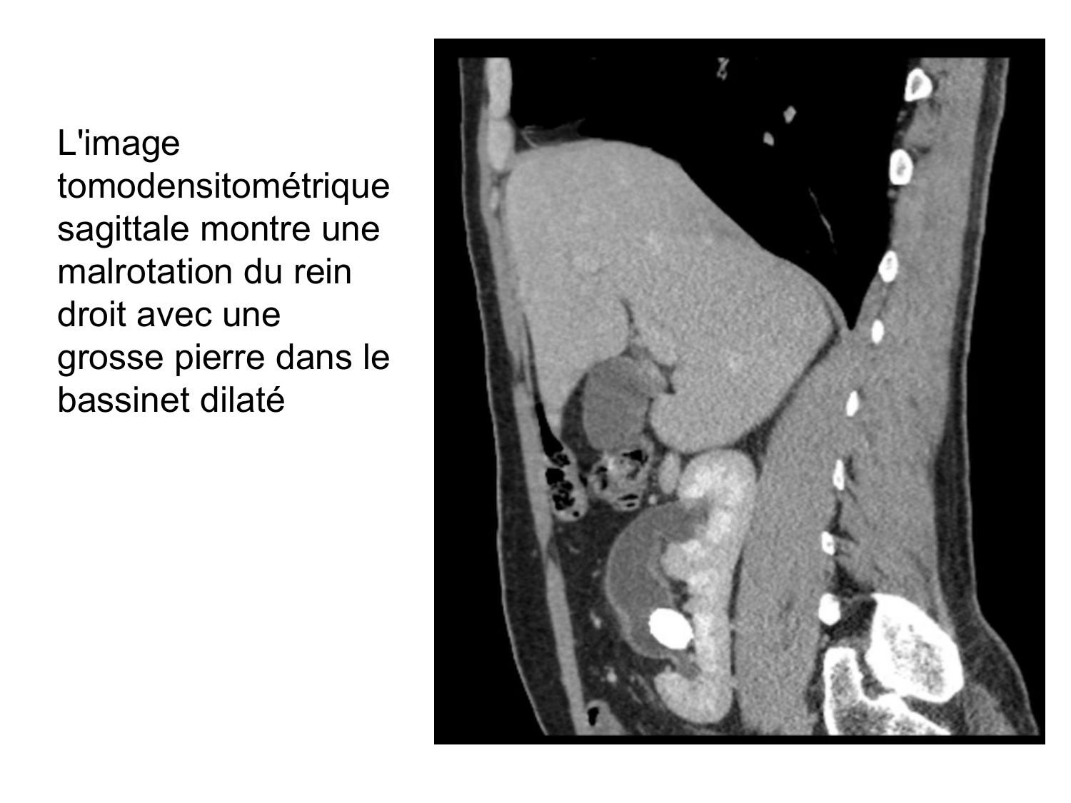 Rein, voies urinaires et retropéritoine page 59