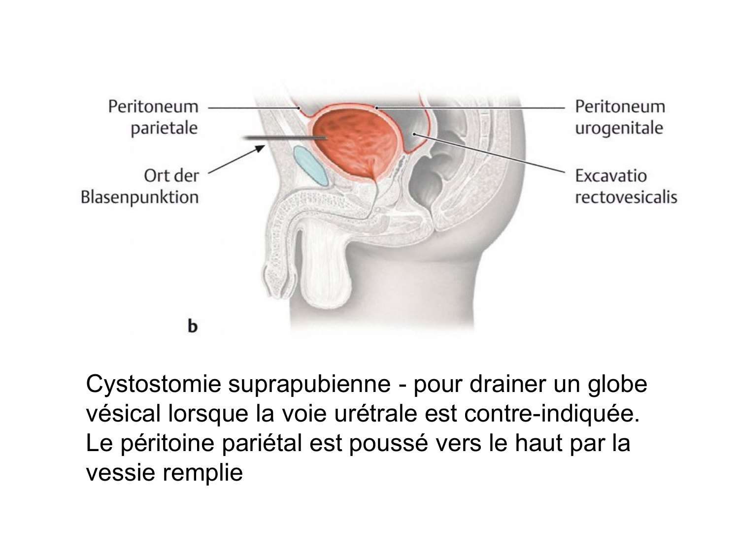 Rein, voies urinaires et retropéritoine page 70
