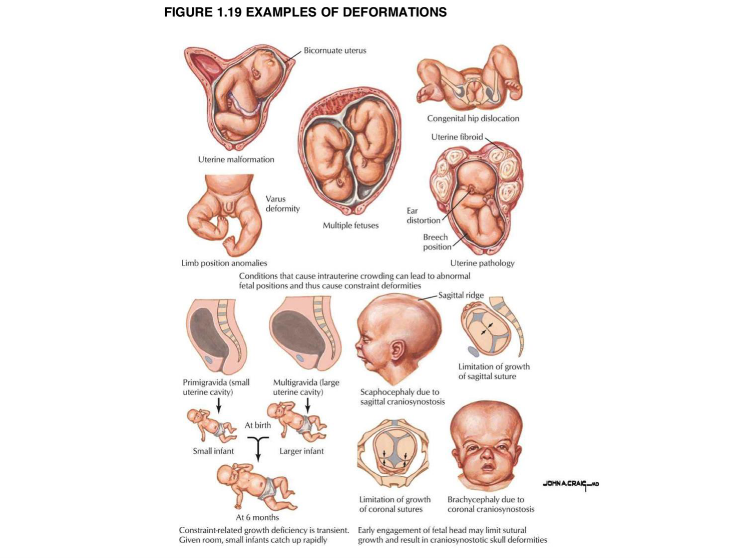 Malformations congénitales page 17