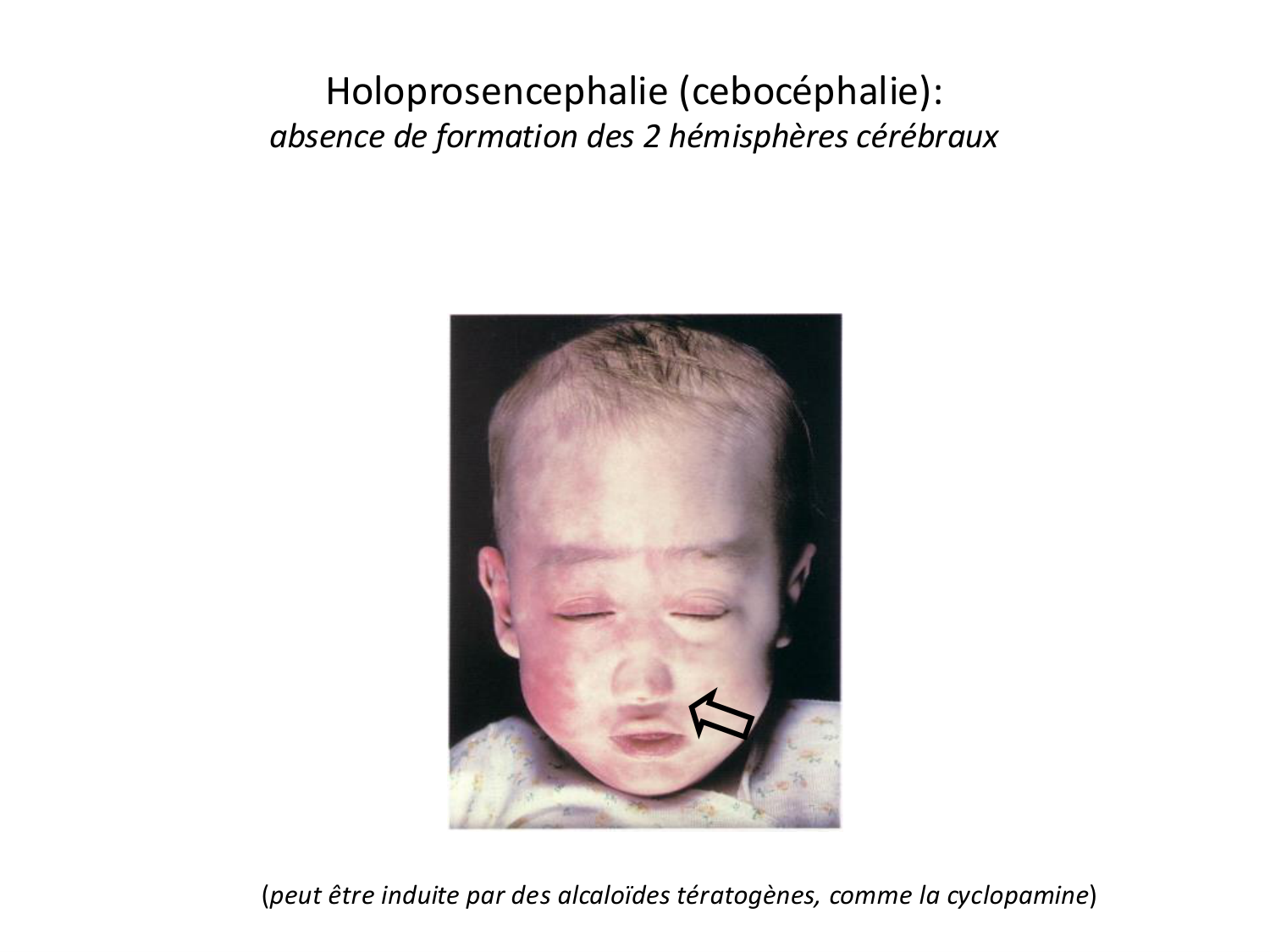 Malformations congénitales page 43