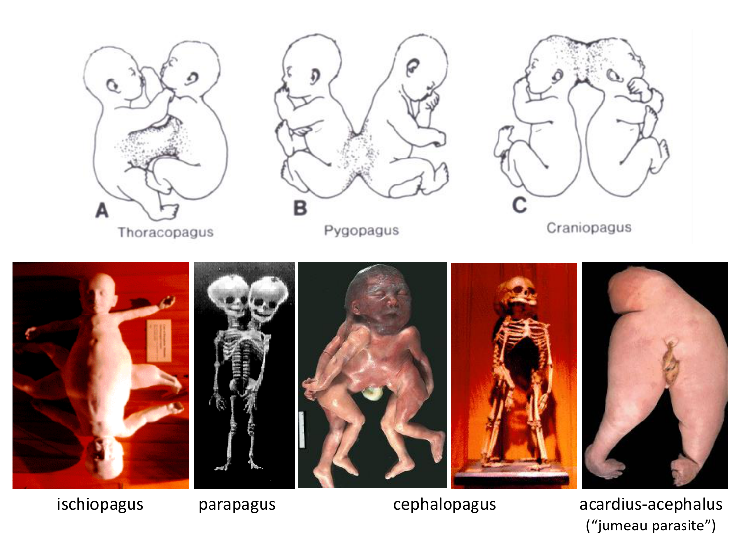 Malformations congénitales page 46