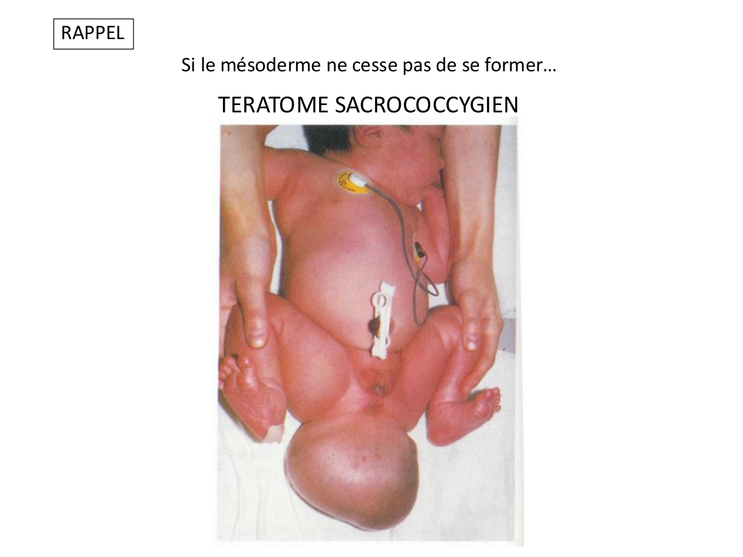 Malformations congénitales page 49