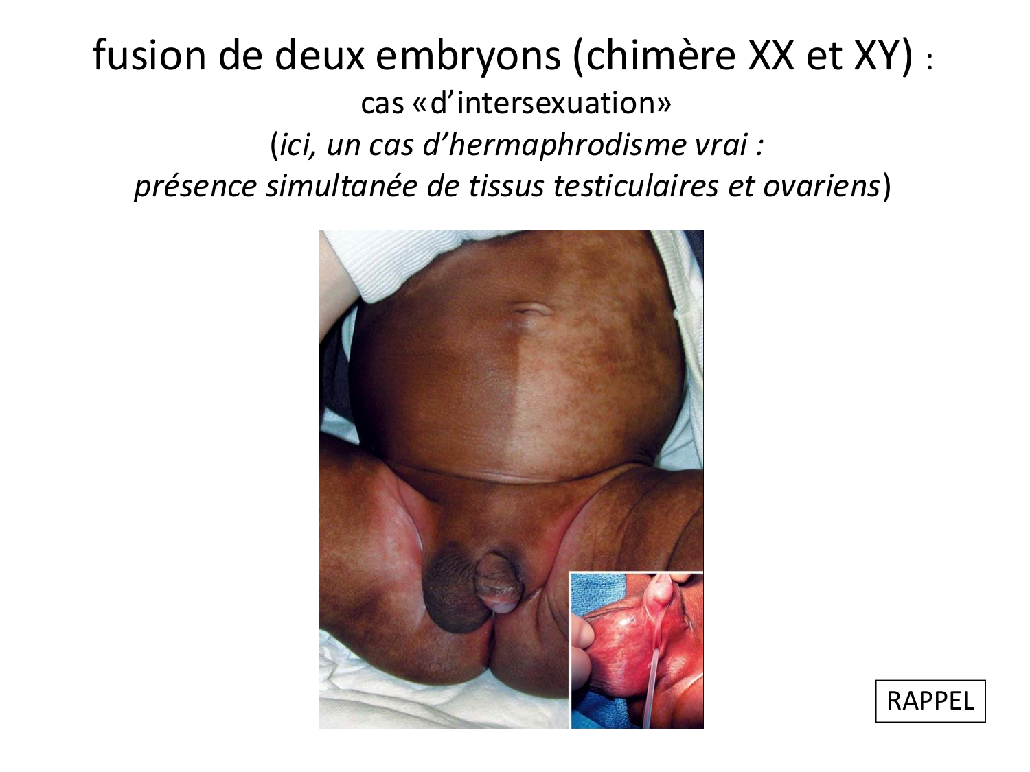 Malformations congénitales page 51