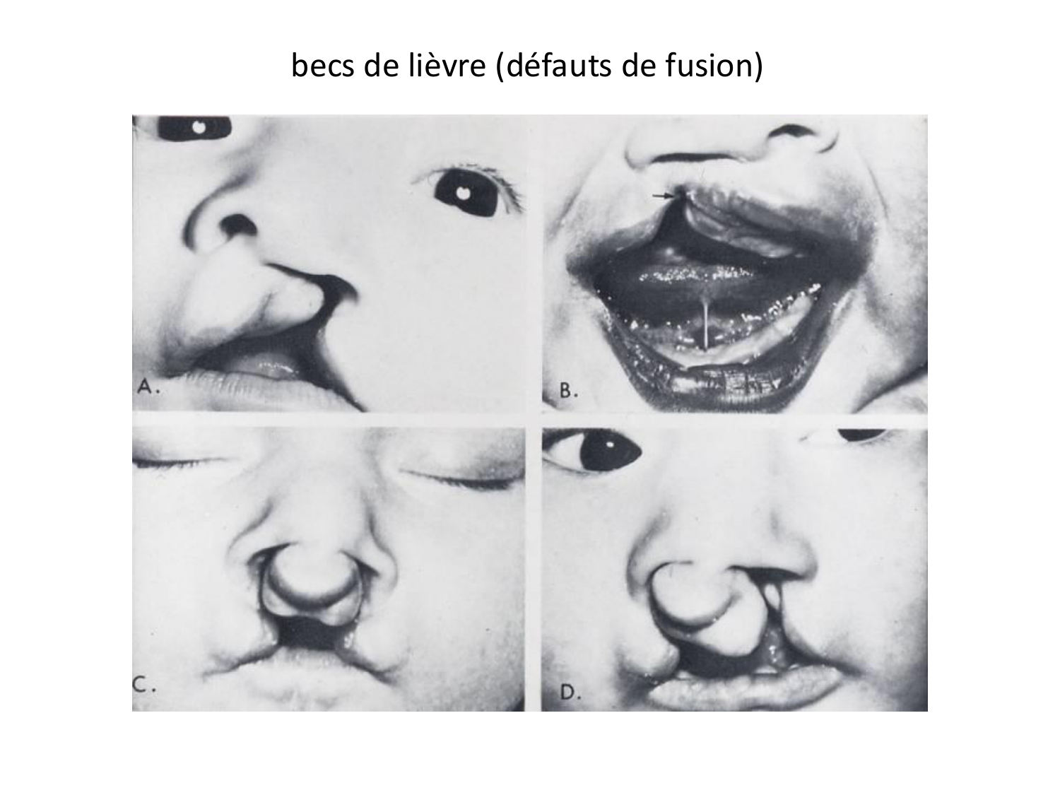 Malformations congénitales page 55