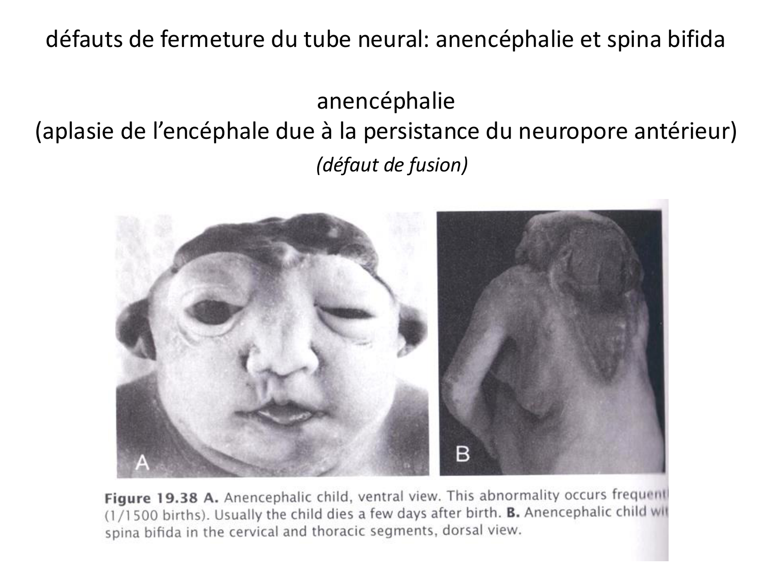 Malformations congénitales page 56