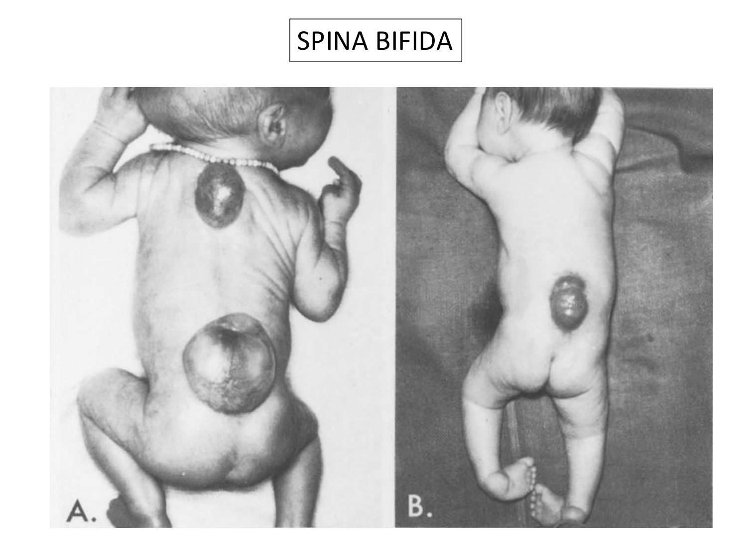 Malformations congénitales page 58