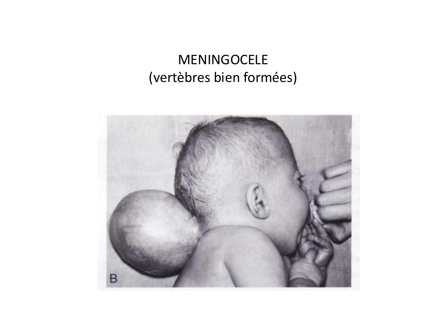 Malformations congénitales page 75