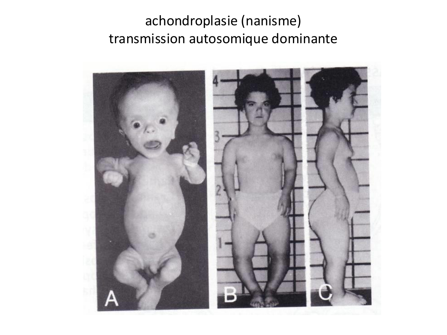 Malformations congénitales page 84