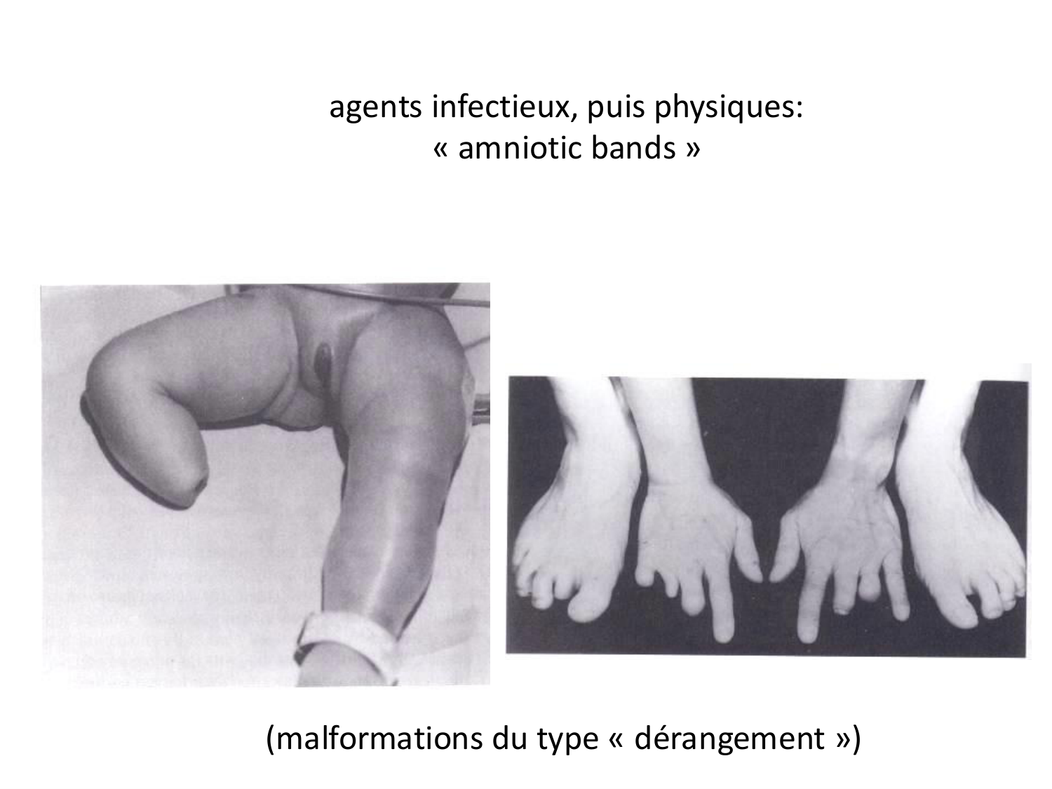 Malformations congénitales page 87