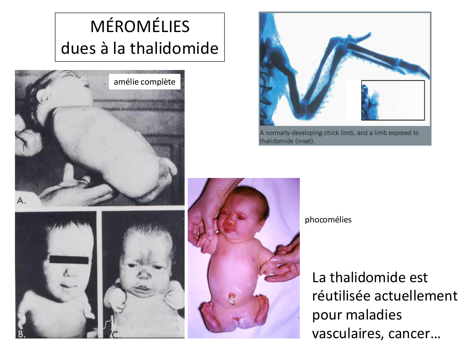 Malformations congénitales page 90