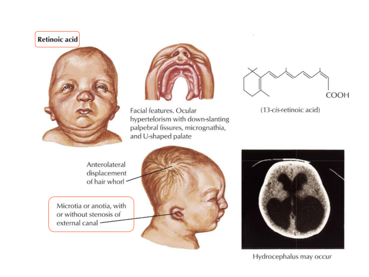 Malformations congénitales page 91
