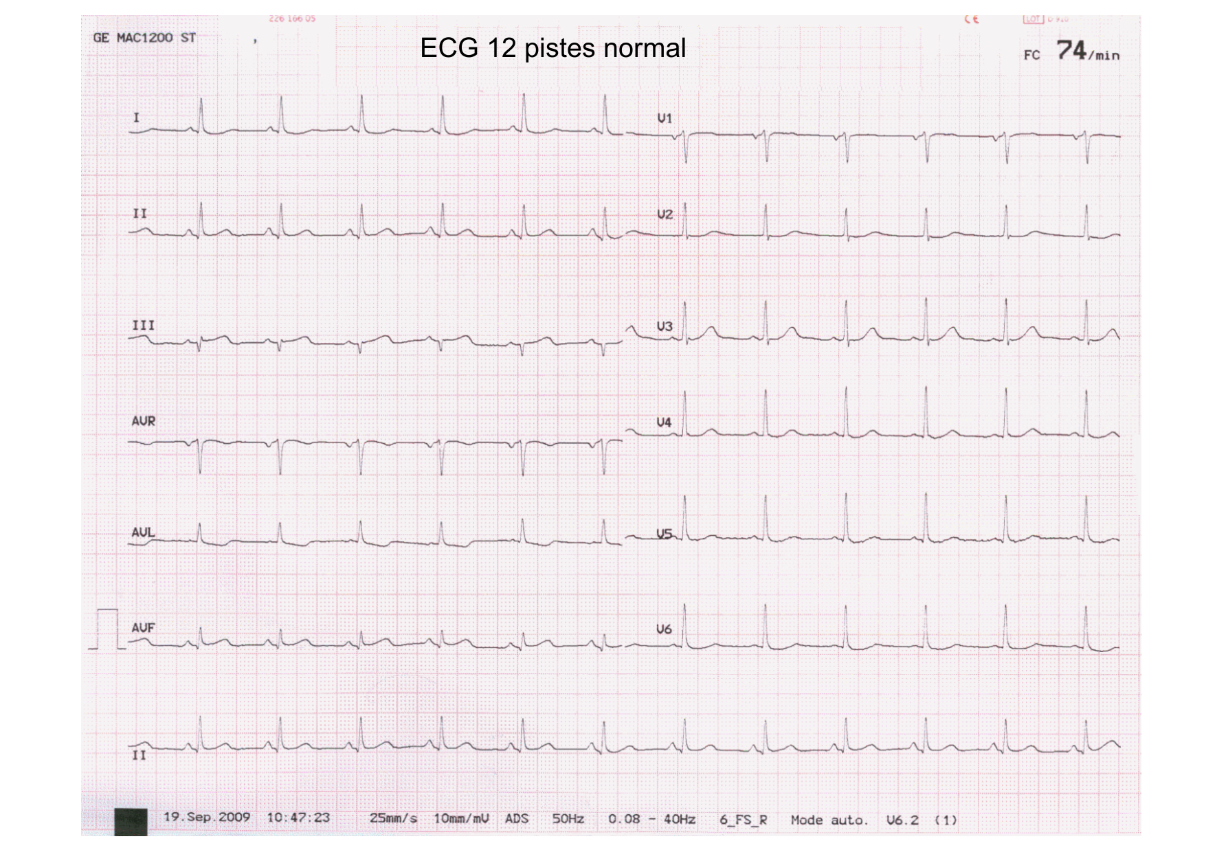 ECG — bases page 22