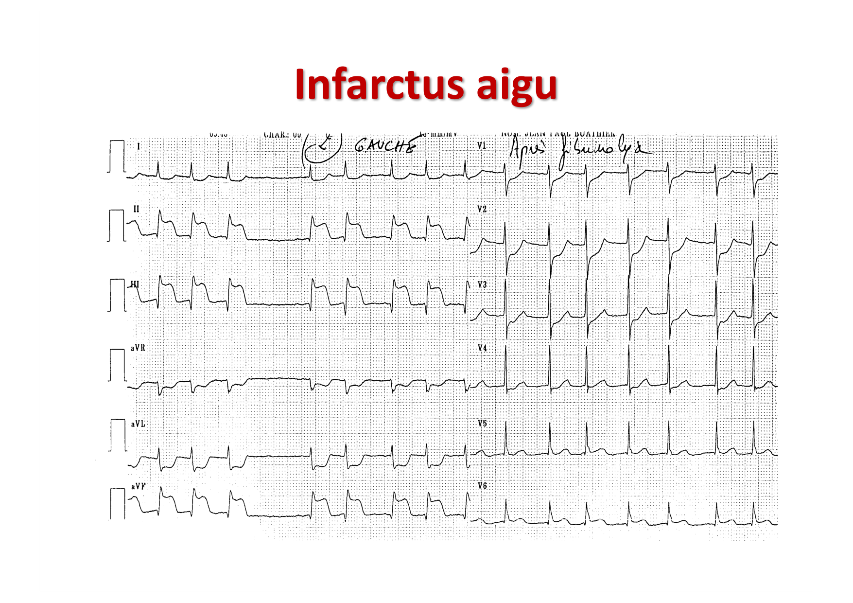 ECG — bases page 24