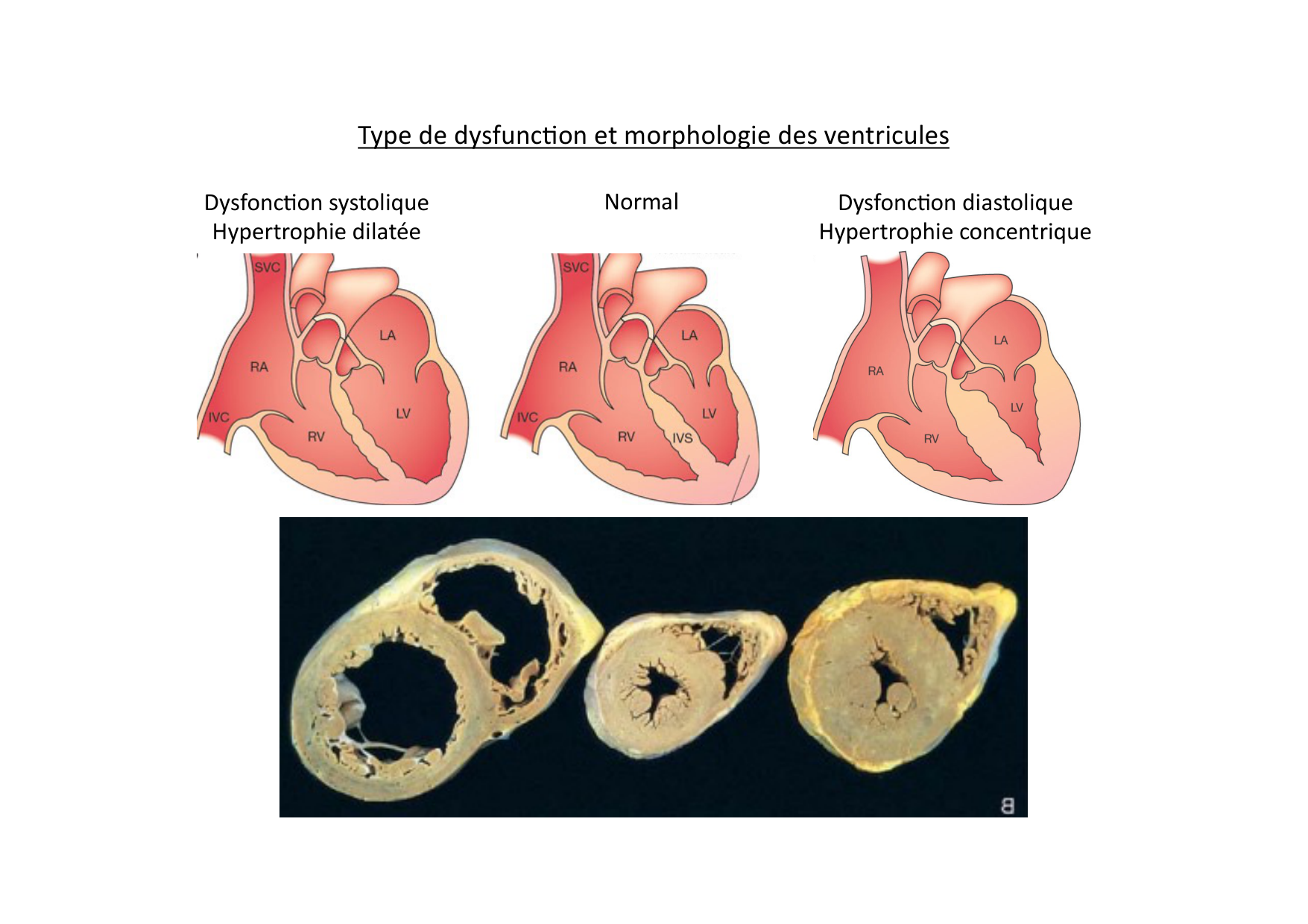 Insuffisance cardiaque page 15