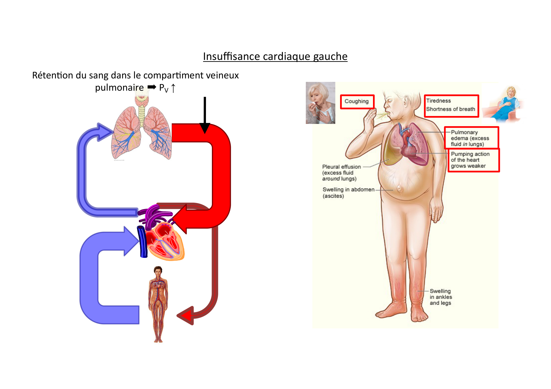Insuffisance cardiaque page 22