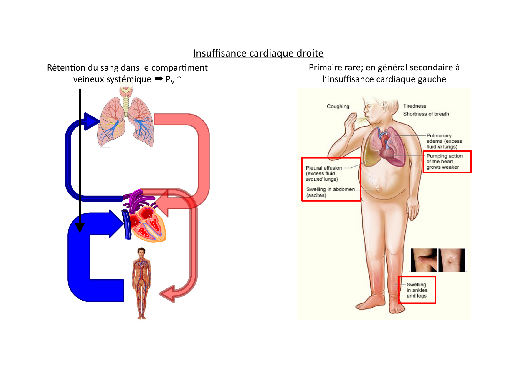 Insuffisance cardiaque page 23
