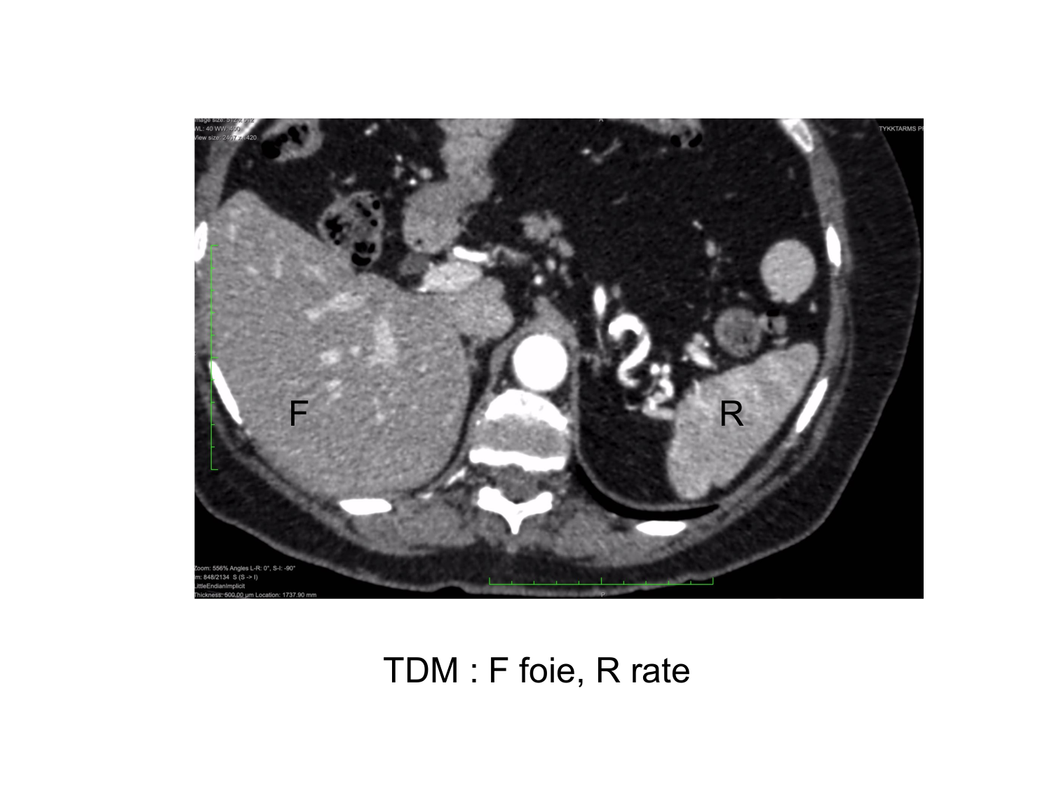 Abdomen gros intestin foie rate pancreas vascularisation page 71