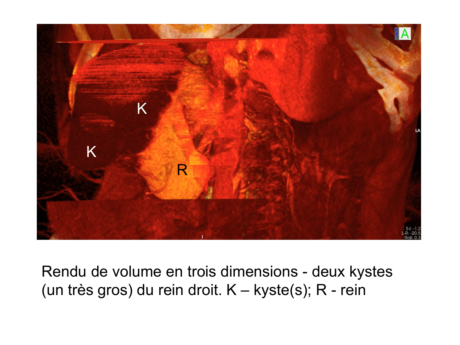 Rein, voies urinaires et retropéritoine page 11