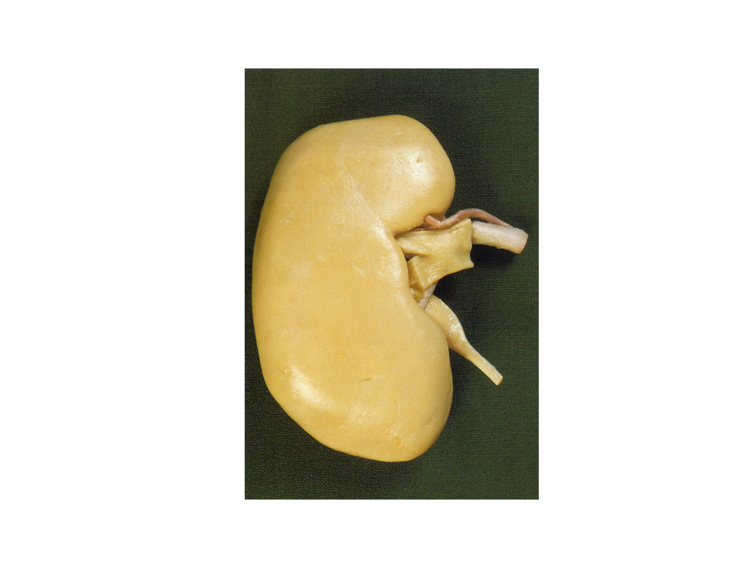 Rein, voies urinaires et retropéritoine page 19