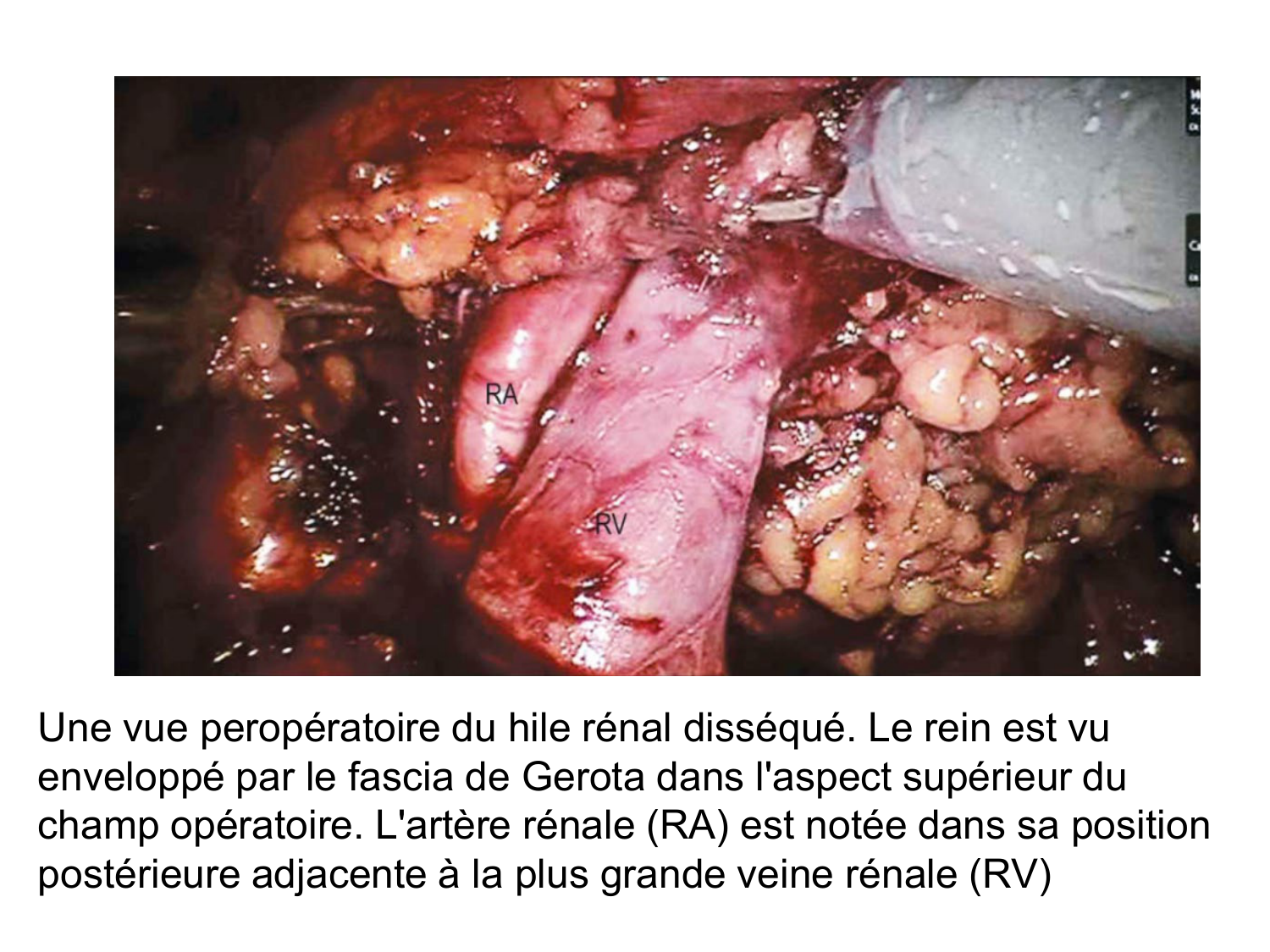 Rein, voies urinaires et retropéritoine page 31