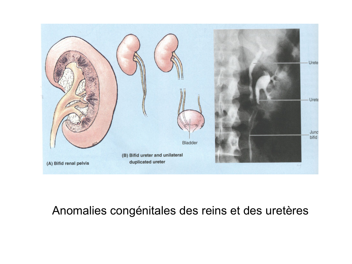 Rein, voies urinaires et retropéritoine page 55