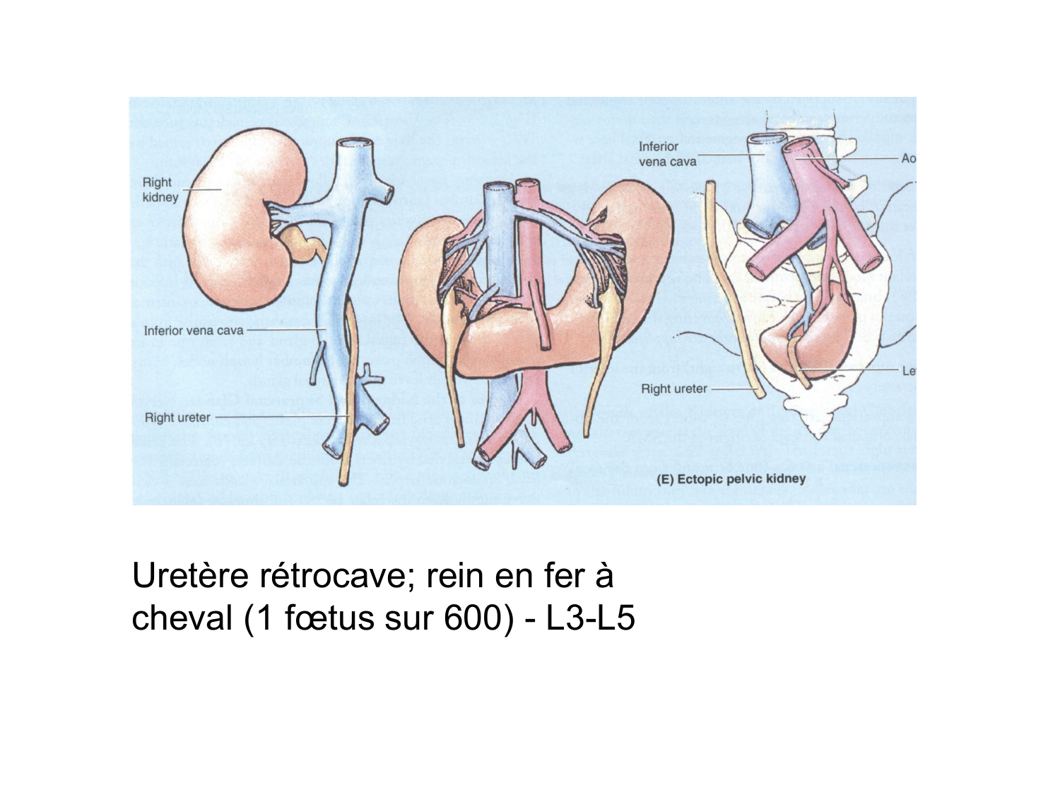 Rein, voies urinaires et retropéritoine page 56