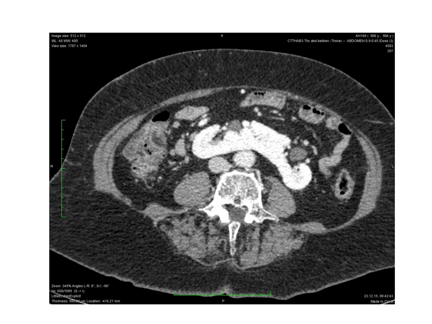 Rein, voies urinaires et retropéritoine page 57