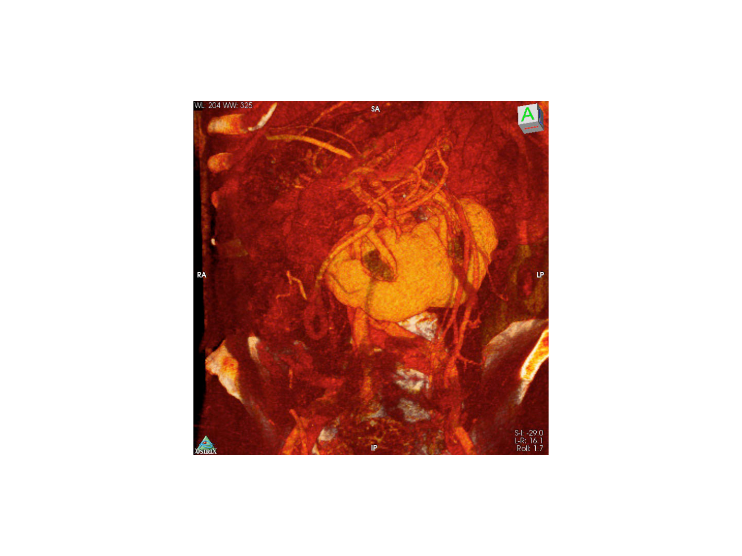 Rein, voies urinaires et retropéritoine page 58