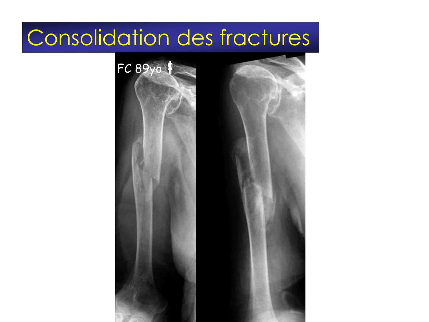 Fractures et réparation page 3